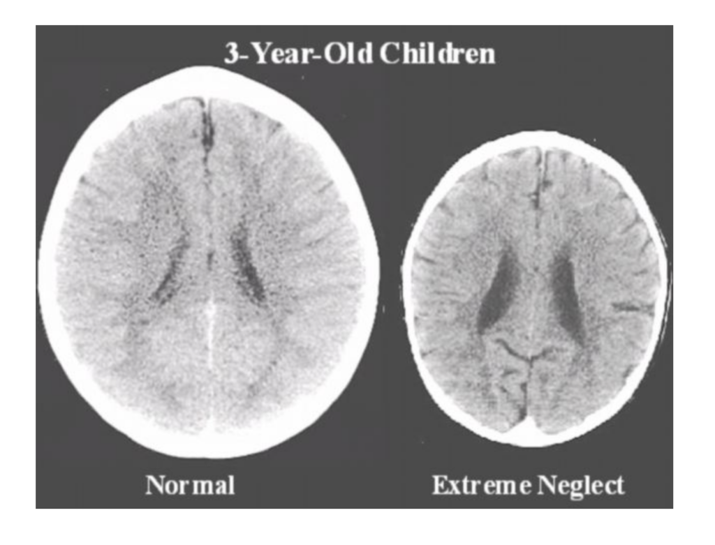 brain scans showing impact of neglect on a child